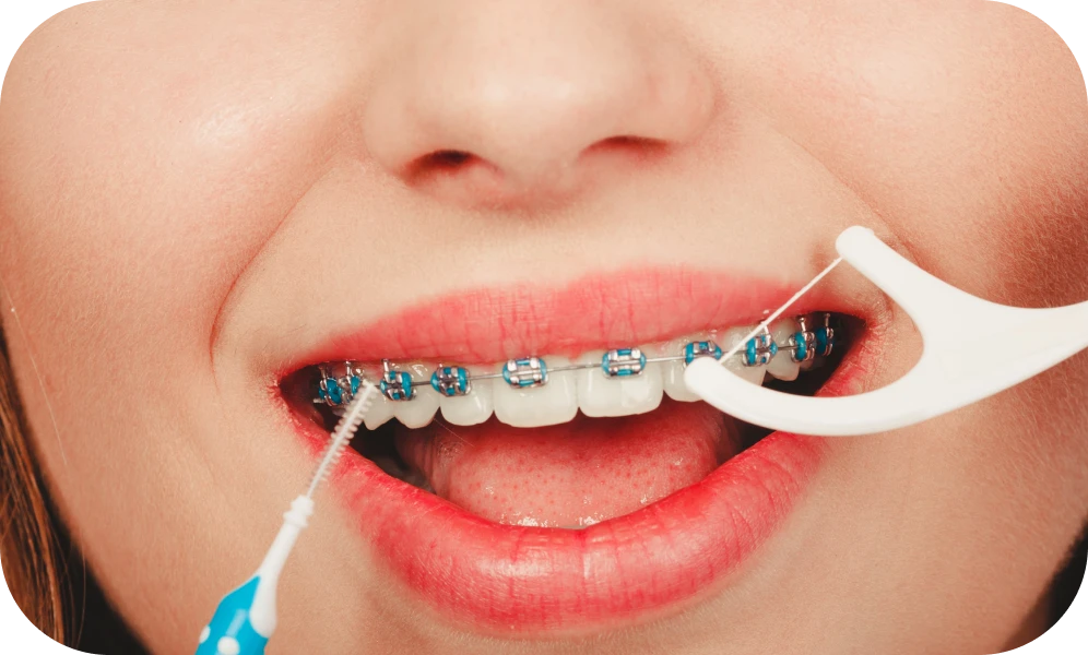 Utilisation d'une brossette interdentaire et d'un fil pour l'hygiène d'un appareil dentaire
