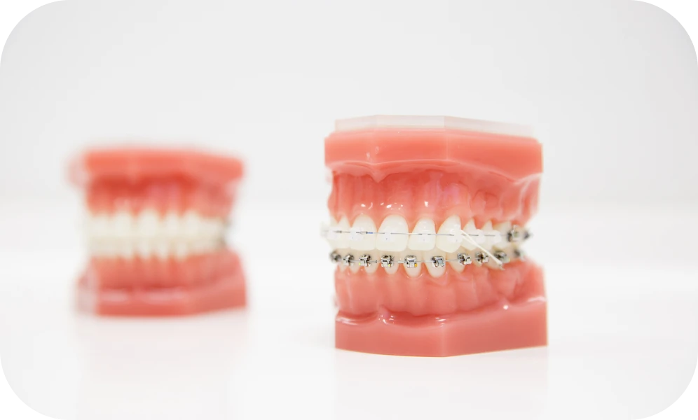 Modèle dentaire présentant un appareil orthodontique avec des élastiques